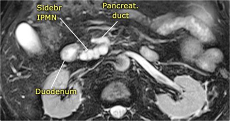 The Radiology Assistant Pancreas Cystic Lesions