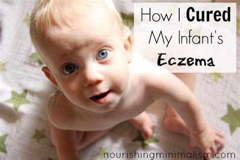 How I Cured My Infants Eczema With Pictures Baby Eczema Baby