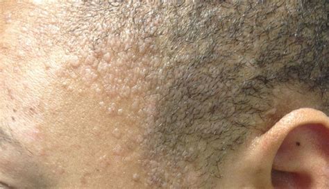 Derm Dx Pink Flat Papules On The Face Clinical Advisor