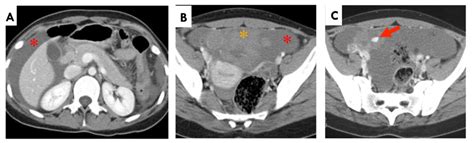 Haemorrhagic Corpus Luteal Cyst Intravenous Contrast Enhanced Axial