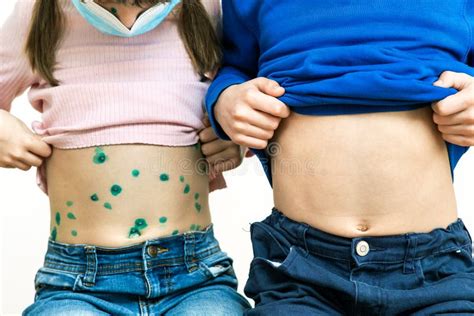 Children Covered With Green Rashes On Stomach Ill With Chickenpox