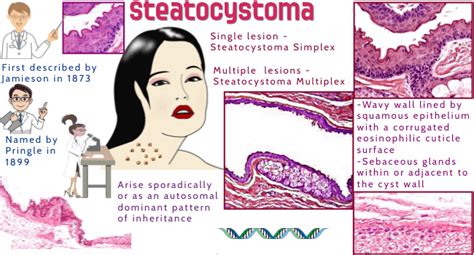Pathology Of Steatocystoma Dr Sampurna Roy Md