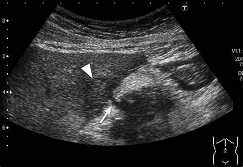 Abdominal Ultrasonography Showed A Connection In The Sagittal Plane