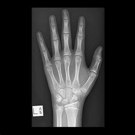 Wrist X Rays Laptrinhx News