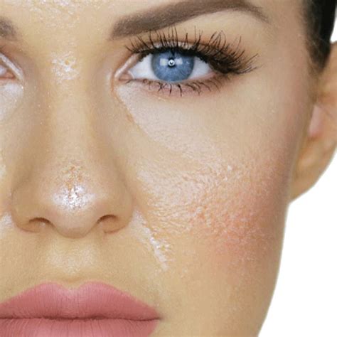 Oily Skin Type • Treatments And Skincare • Nascent Skin Clinic
