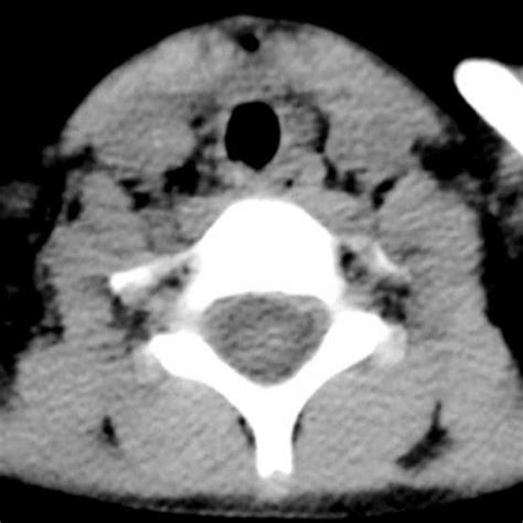 Cervical Computed Tomography Scan Of The Neck Showing Tracheal