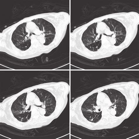Chest Ct Scans Shown Signs Of Pneumonia Download Scientific Diagram