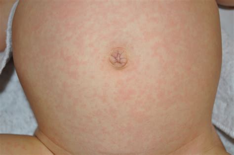 Baby Rash Pictures Causes Treatments Mommyhood Advice The Best