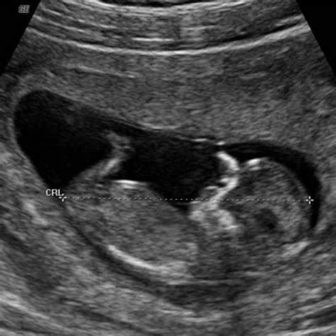 At this juncture, as an expectant mother, you will to be very cautious about what you eat and do considering that you will be taking care of the baby as well. Week 12 Ultrasound: What It Would Look Like | Parents