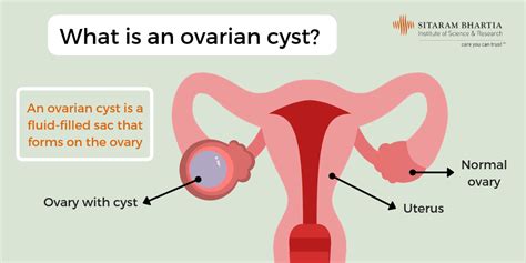 ovarian cyst is surgical treatment the right option