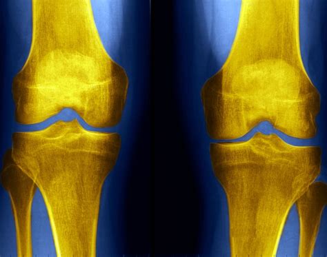 Knee X Rays And Detecting Abnormalities
