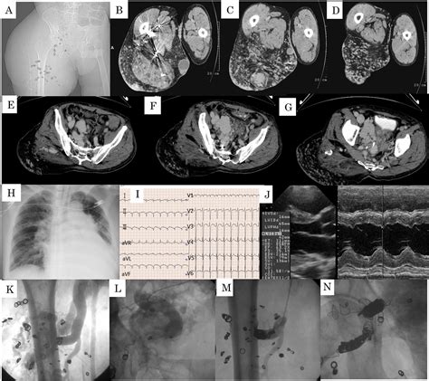 An Autopsy Case Of Parkes Weber Syndrome With High Output Heart Failure