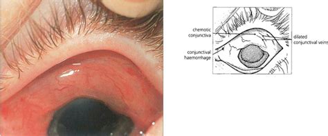 The Conjunctiva Diseases And Tumours Ento Key