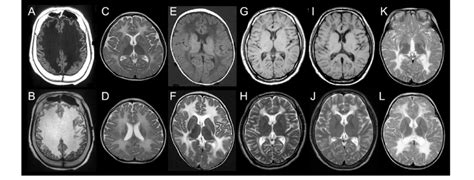 Brain Mri Findings Of The Patients Examined Axial Images Show Various