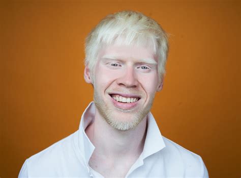 Sabemos Que O Albinismo é Uma Anomalia
