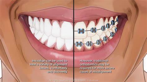 How To Know If You Need Braces Or Invisalign Everything You Need To
