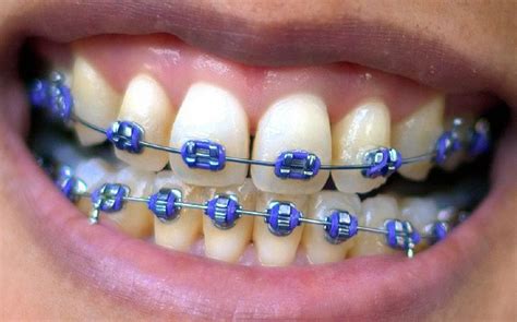 Asian Teenagers Flock To Get Fashion Braces