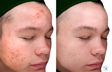 Skin Care Programs Chemical Peels Before After Photos Patient My Xxx