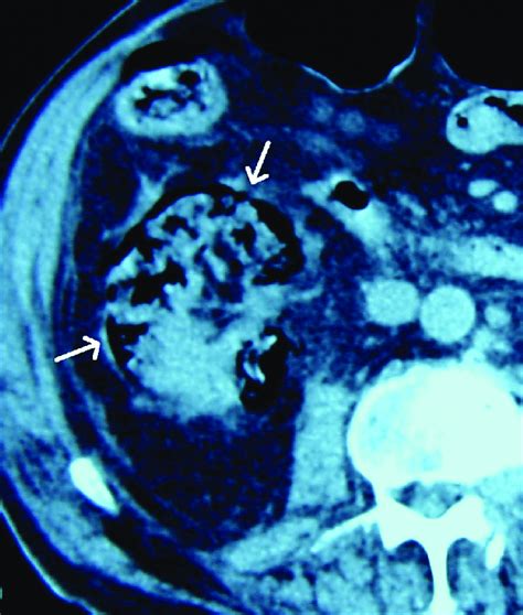 Abdominal Ct Scan Showing Air Inside And Peripheral To The Right Kidney