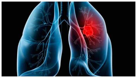 Que Es Una Trombosis Pulmonar Papel De La Ecocardiografia