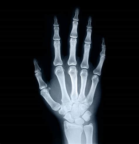 Pictures Of Hands With Rheumatoid Arthritis Pictures Stock Photos