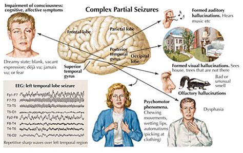 Partial Seizures Symptoms