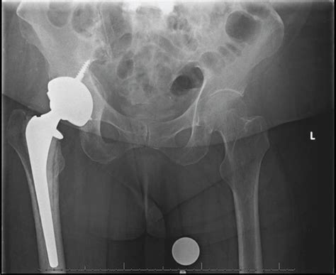 Ap Pelvis Radiograph Obtained 2 Weeks After Revision To Total Hip