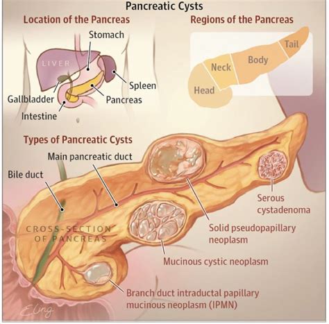 Pancreatic Cancer Stages Sounds Better Vlog Art Gallery