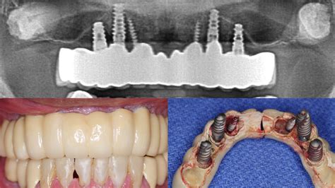 Treatment Of A Patient With Full Mouth Dental Implant Complications Treatment Of A Patient