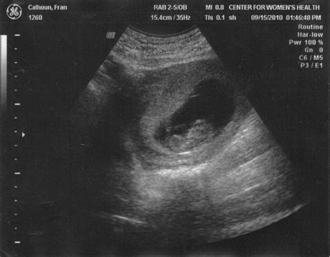 3 Месяца Беременности Фото Плода — Картинки фотографии