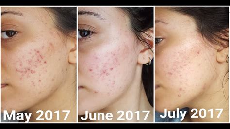 2 Months On Accutane Or Isotretinoin Uk Youtube