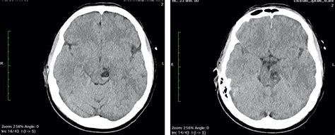 Cureus Bleeding Of Perivascular Spaces In Midbrain Of A Young Patient