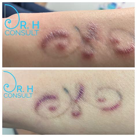 Hypertrophic Scar Treatment Removal London Dr H Consult