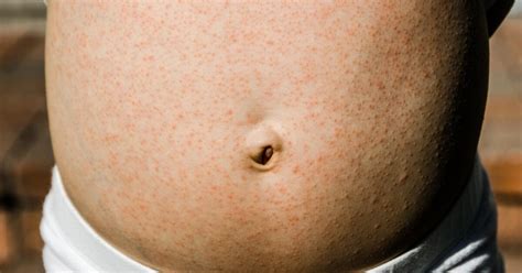 Affirmer Fuite Comptable Red Spots On Abdomen Not Itchy Scientifique