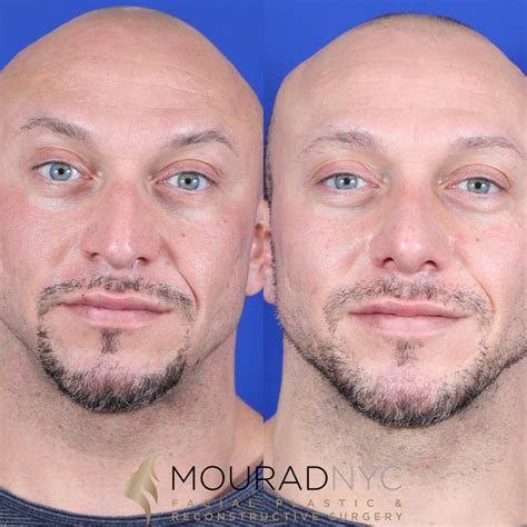 Male Deviated Septum Rhinoplasty Before And After Facial Plastic
