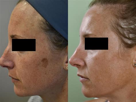 Ipl Treatment Before And After Pictures Of Actual Patients