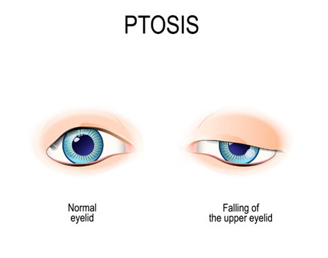 Overview Of Ptosis Causes And Treatment Fort Lauderdale Eye Institute