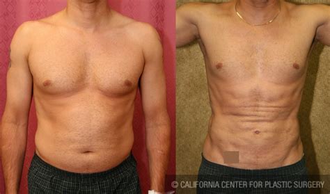 Patient Male Liposuction Abdomen Before And After Photos Beverly Hills Plastic Surgery