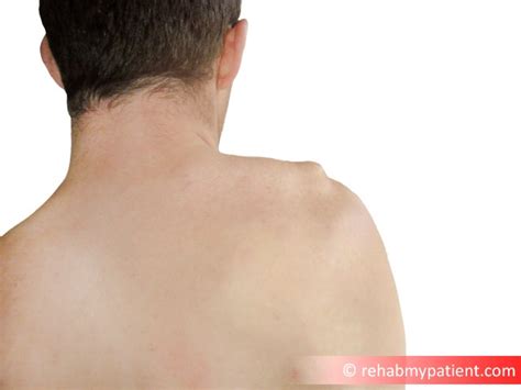 The human neck is made up of 7 smaller vertebrae that consist of consequently, the body will make bone spurs in the neck which limits the range of movements ☑ over the counter medications are generally prescribed by doctors for treating such type of body pain. Acromioclavicular Joint Sprain | Rehab My Patient