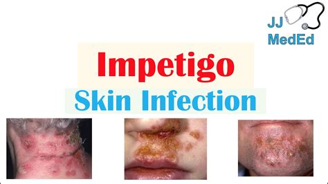 Introduction To Impetigo Infection Subtypes And Treatment Youtube