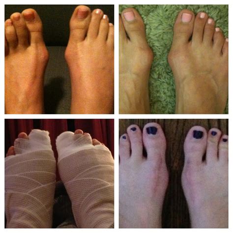 Documenting My Double Bunionectomy Bunion Surgery Experience