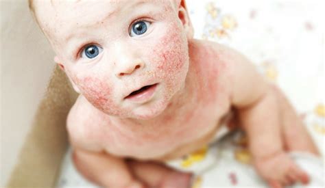 How To Treat Eczema For Kids Mydcsi