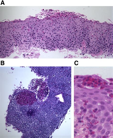 Eosinophilic Esophagitis In Children And Adults A Systematic Review