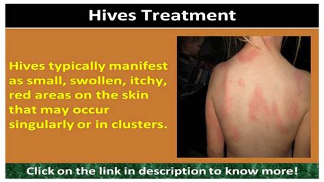 Allergic Reaction Hives Treatment Youtube