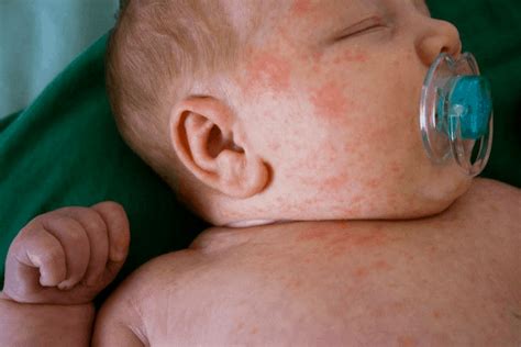 Alergias En Bebés ¿cómo Detectarlas Cuidados Y Mucho Más Hablemos