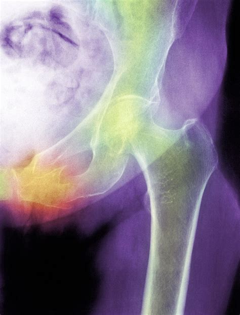 Hip Fracture Due To Osteoporosis Photograph By Medical Photo Nhs Lothian