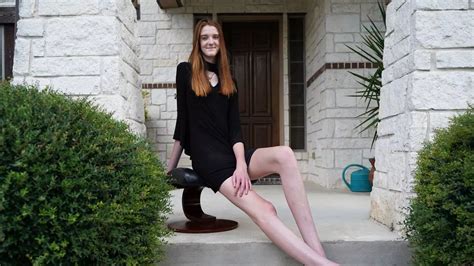 Teenager Breaks Double World Records For Longest Legs And Is Heading