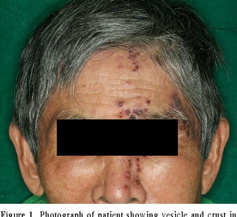 Figure 1 From A Case Of Multiple Complications In Herpes Zoster