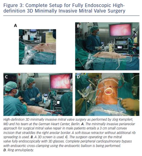 Figure 3 Complete Setup For Fully Endoscopic Highdefinition 3d
