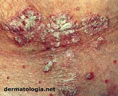 Uma leitora perguntou se existe algum creme, shampoo ou tratamento para tratar a psoríase. Psoríase - Dermatologia.net